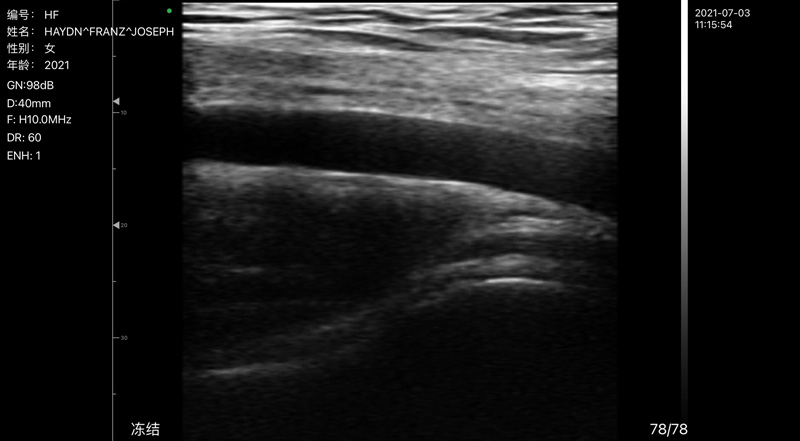 Wireless Ultrasound for Arteri aksila C