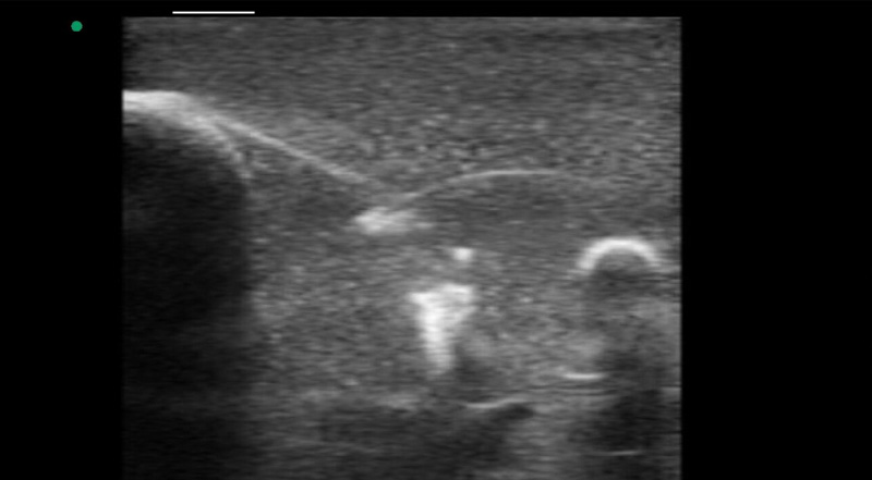 Wireless Ultrasound for Pelatihan biopsi payudara