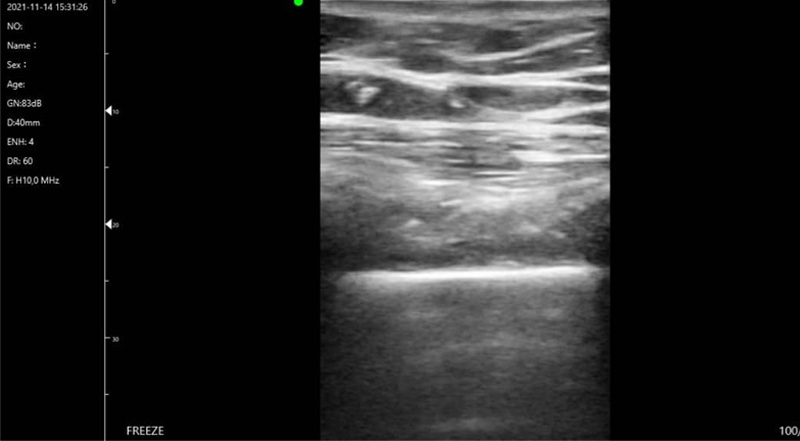 Wireless Ultrasound for Paru C10T