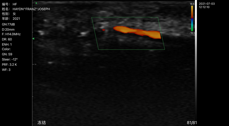 Wireless Ultrasound for Arteri jari