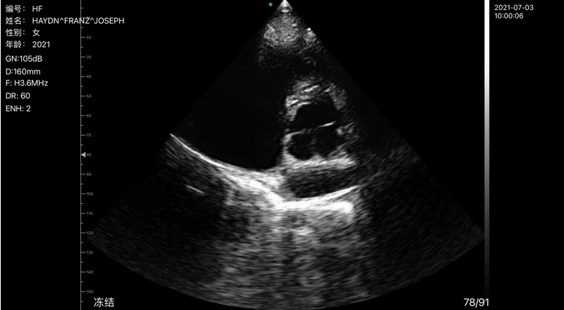 Wireless Ultrasound for Katup Mitral
