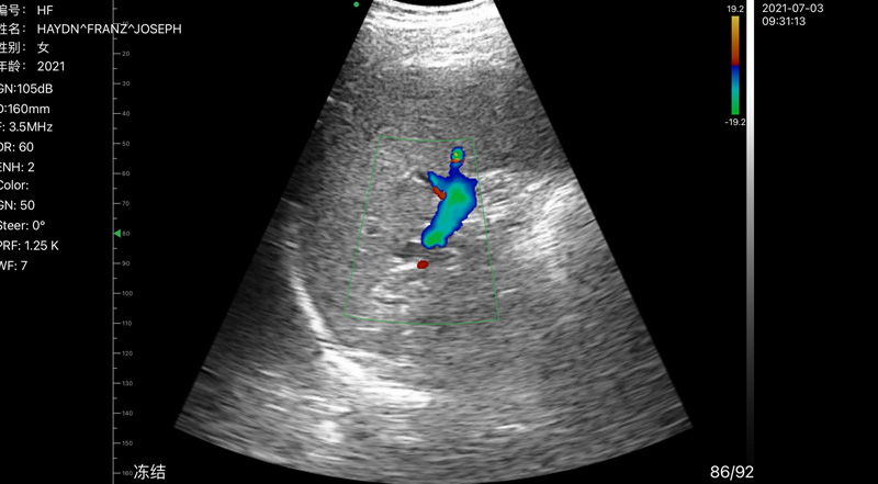 Wireless Ultrasound for Ked