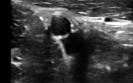 Ultrasound perut transduser Iliac arteri B