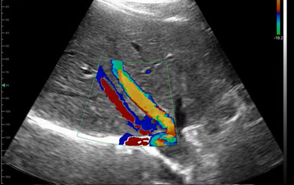 Convex Array transduser Liver C