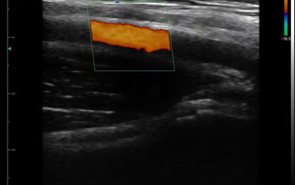 Array Linear Probe Ultrasound Artery aksial C