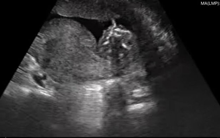 Ultrasound janin B seluruh tubuh perut