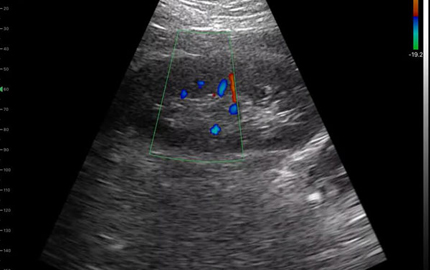 Pemindai ginjal Ultrasound seluruh tubuh