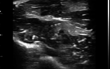 Saraf Median Probe Linear melengkung