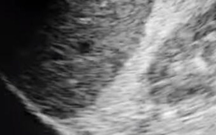 Genggam Ultrasound medis HCM efusi pleoral