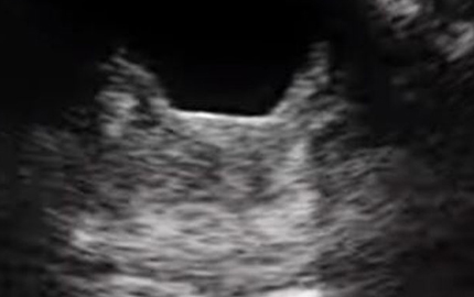 Perangkat Ultrasound portabel genggam asites prostat kantung kemih